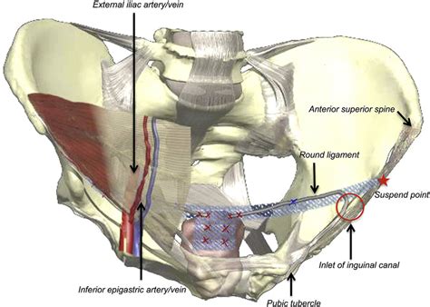 Schematic representation depicting laparoscopic inguinal ligament... | Download Scientific Diagram