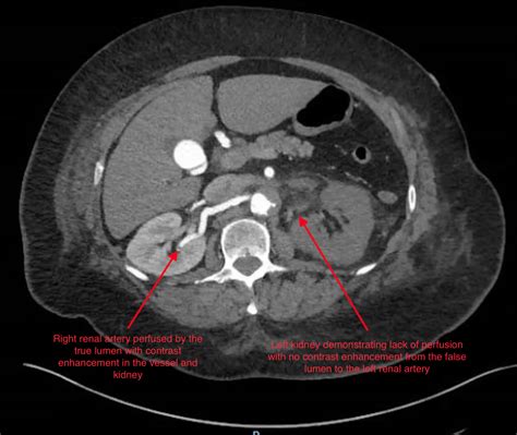 Renal Infarction from Type B Aortic Dissection - JETem