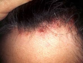 Scalp folliculitis | DermNet