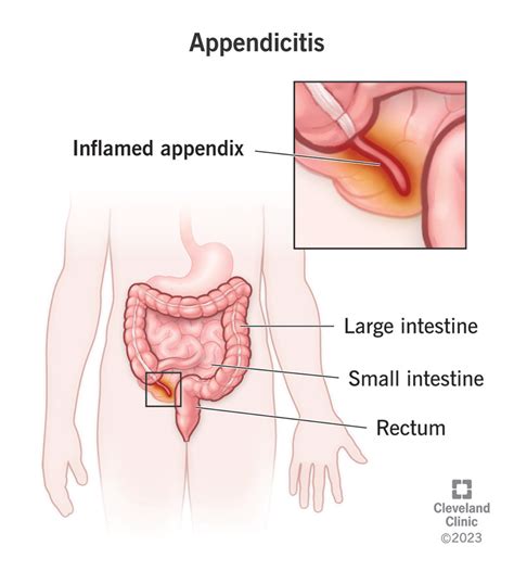 Appendicitis: Signs & Symptoms, Causes, Diagnosis & Treatment