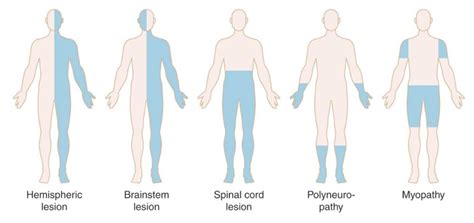 Neuromuscular Weakness | RECAPEM