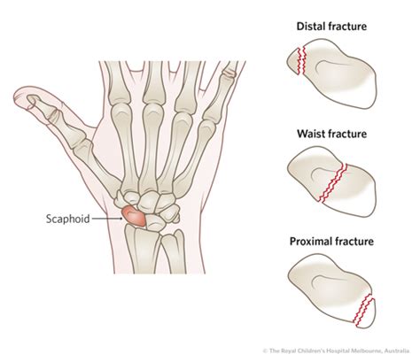 Scaphoid Fracture Cast Or Splint