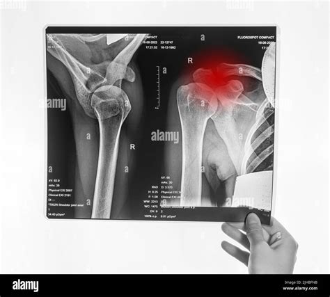 Hand holding shoulder, clavicle X-ray image with red point. Acromion ...