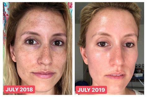 This Woman's Reddit Before-And-After Sun Damage Photo Is, 57% OFF