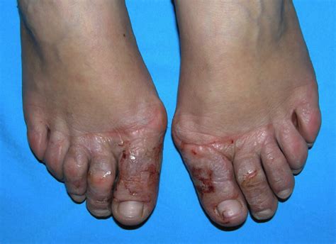 Shoe contact dermatitis, causes, symptoms, diagnosis & treatment