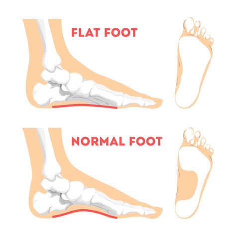 Flat Feet: Symptoms, Causes and Stages | Seaview Orthopaedics