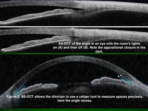 Role of oct in glaucoma