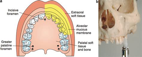 Local and Regional Anesthesia in Dental and Oral Surgery | Anesthesia Key