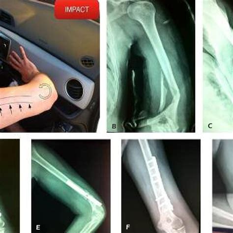 A, Illustration of the trauma mechanism of spiral humerus fracture with... | Download Scientific ...