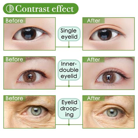 Single Eyelid Vs Double Eyelid