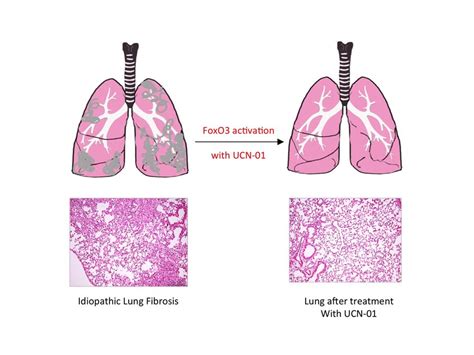 Pulmonary fibrosis caused by single transcription factor | Max-Planck ...