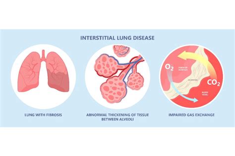 Interstitial Lung Disease (ILD) in Singapore - Dr Akash Verma