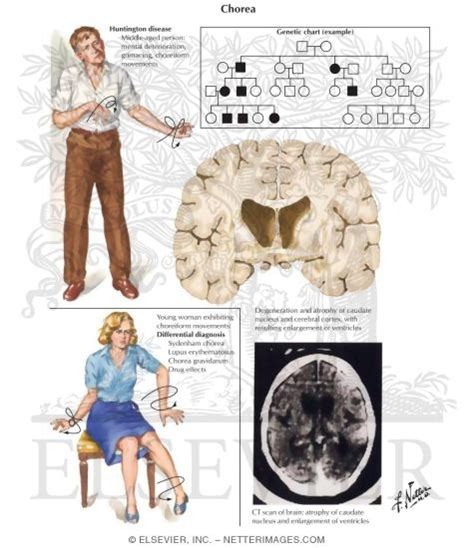 Huntington disease; Huntington Chorea; Juvenile Huntington Disease