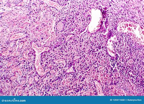 Cholecystitis Histology