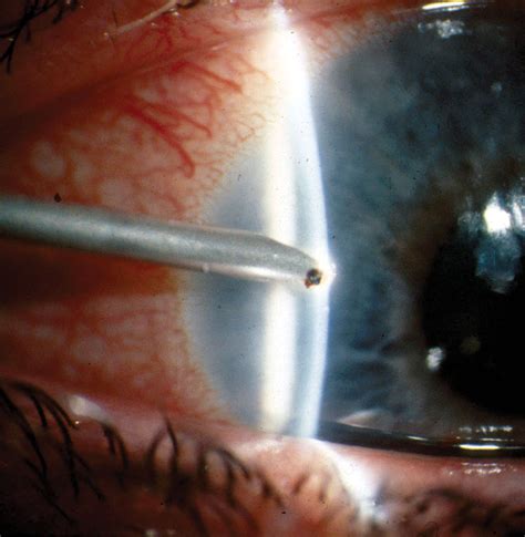 Clinical Pearls in Corneal Foreign Body Removal