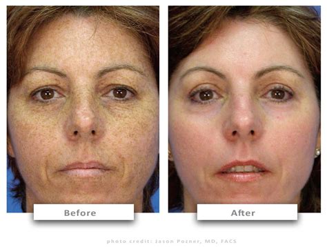 Laser Peel – Contour TRL™ skin resurfacing - For unparalleled wrinkle reduction and improvements ...