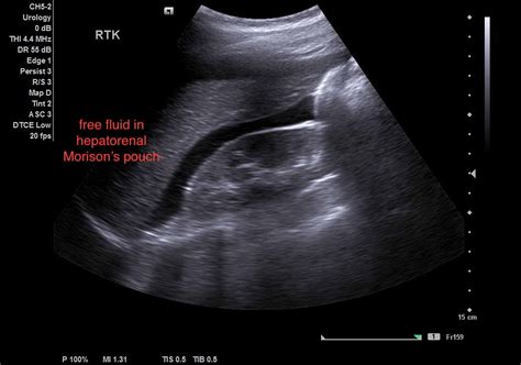 Ruptured Ectopic Pregnancy Ultrasound