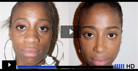 African American Rhinoplasty | Nose Job For African Americans