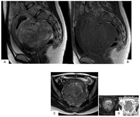 Healthcare | Free Full-Text | Differential Diagnosis of Uterine ...