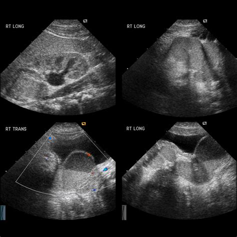 Pediatric Duplicated Kidney | Pediatric Radiology Reference Article | Pediatric Imaging ...