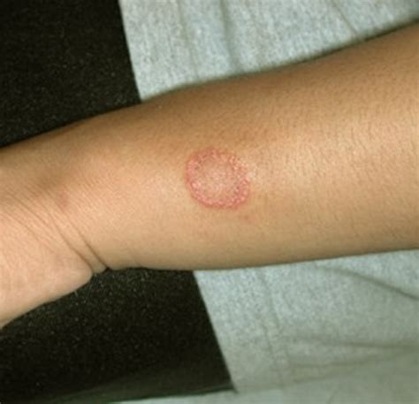 Tinea Corporis - Pictures, Treatment, Causes, Symptoms - HubPages