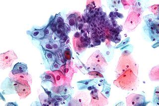 Pap smear - wikidoc