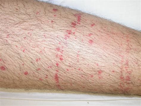 Petechiae - Pictures, Causes, Diagnosis, Treatment and Cure