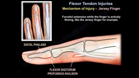 Flexor Tendon Injuries — OrthopaedicPrinciples.com