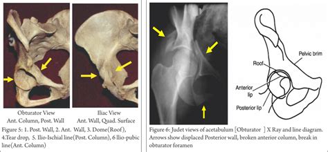 Acetabular fractures Archives - Trauma International