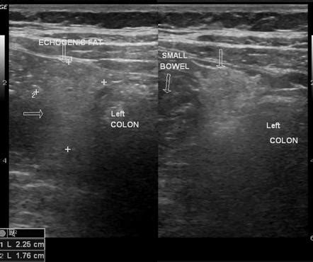 Epiploic appendagitis | Radiology Case | Radiopaedia.org