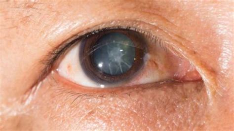 These Eye Drops Can Treat Cataract Without A Surgery