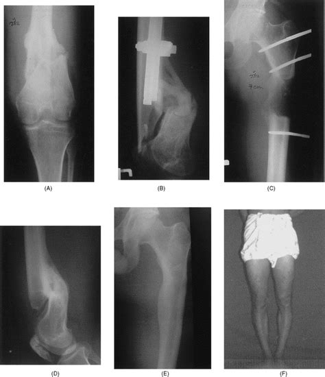 Distraction osteogenesis for the treatment of post traumatic complications using a conventional ...