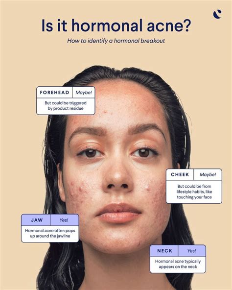 Everything you need to know about hormonal acne | Curology | Hormonal ...