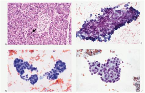 Neuroendocrine Tumors of the Pancreas | Basicmedical Key