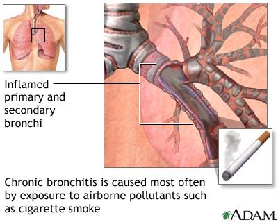 Acute bronchitis: MedlinePlus Medical Encyclopedia