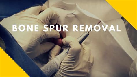 Ostectomy - Bone Spur Removal - YouTube