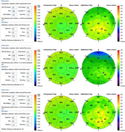 Anterior-segment OCT imaging pachymetry maps for cornea (left) and ...