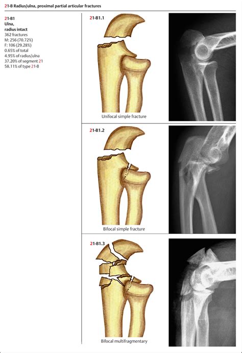 Proximal Ulna Fracture | sexiezpix Web Porn