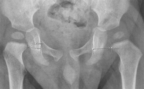 Transient Synovitis of Hip - Pediatrics - Orthobullets