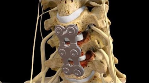 C5-6/C6-7 Anterior Cervical Discectomy with Fusion | Spinal fusion ...