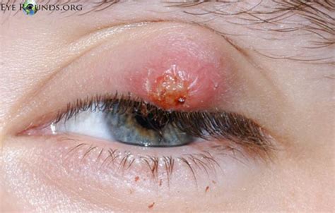 Chalazion Causes, Symptoms, Home Treatment, Surgery, Pictures | eHealthStar