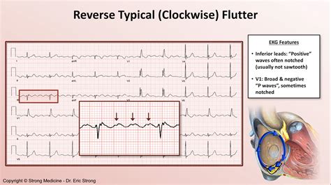 Typical Atrial Flutter Ekg