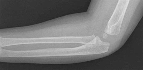 2 1/2-year old has swollen elbow after falling - Journal of Urgent Care Medicine