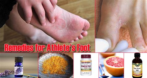 17 Home Remedies for Athlete's Foot