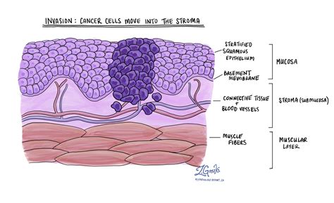 Squamous cell carcinoma of the larynx - MyPathologyReport.ca