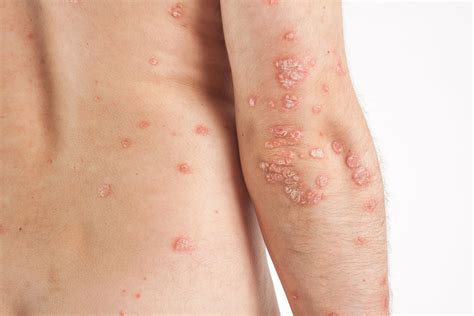 Inilah Psoriasis, Penyakit Autoimun Yang Berimbas Pada Kulit | Lifepack.id