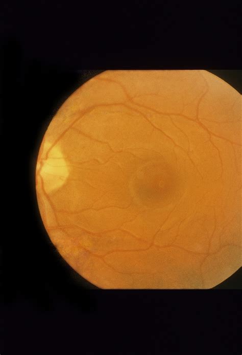 Paracentral Scotoma - Retina Image Bank