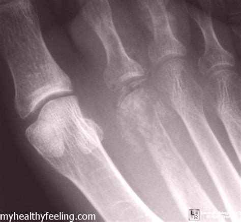 Osteomyelitis pictures, symptoms, treatment, causes