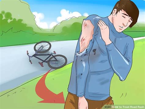 How to Treat Road Rash (with Pictures) - wikiHow