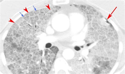 RiT radiology: Crazy-Paving Pattern